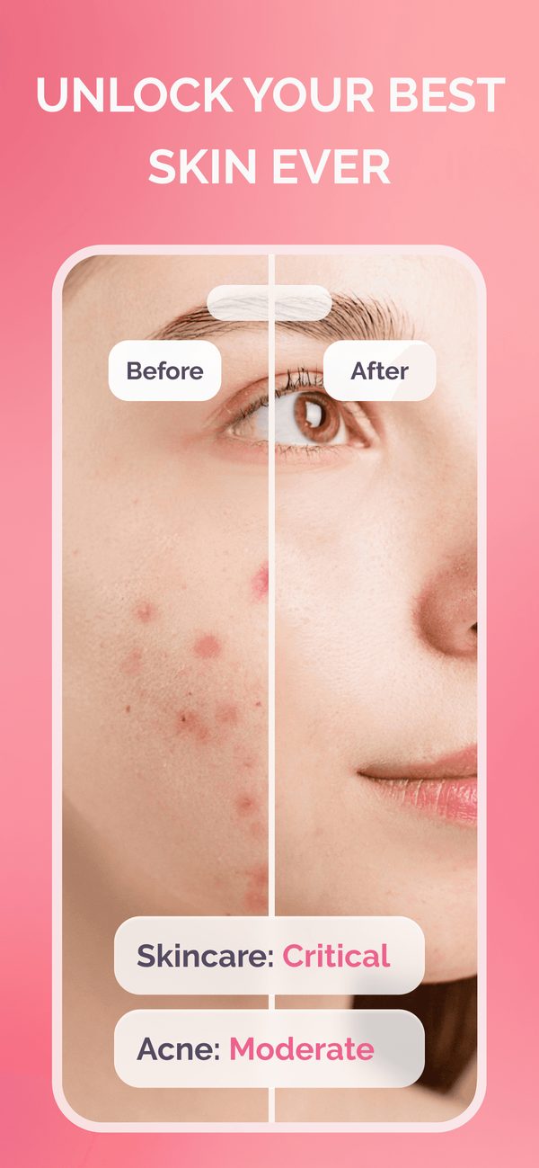 Skin analysis with before and after photo, skincare and acne rating